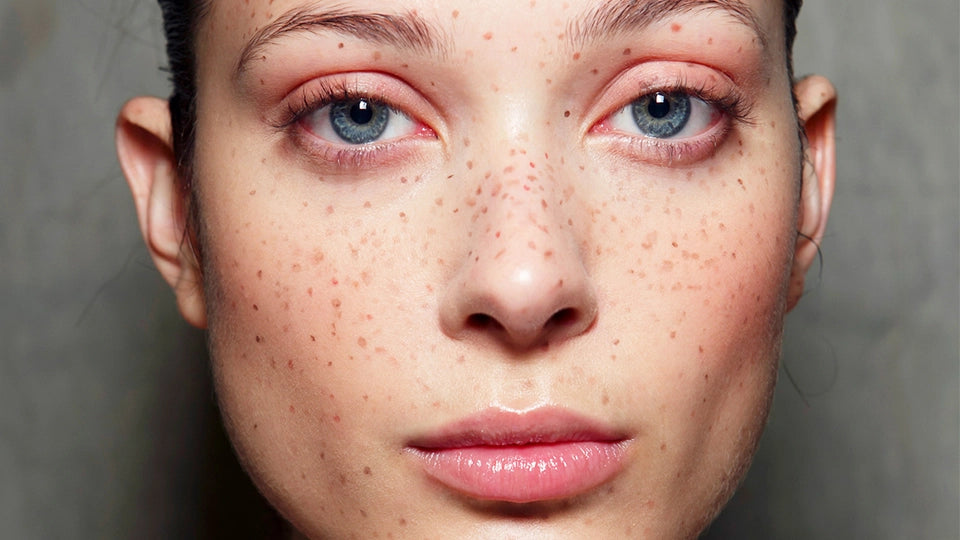 Freckle Tattoos: The Latest Semi-permanent Makeup Trend.